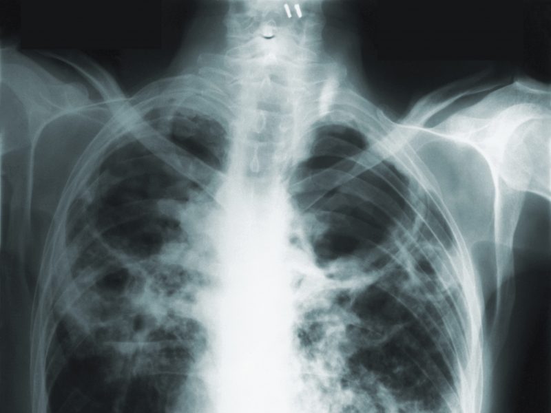 Varje år dör minst 1,5 miljoner människor i lungsjukdomen tuberkulos över hela världen.
